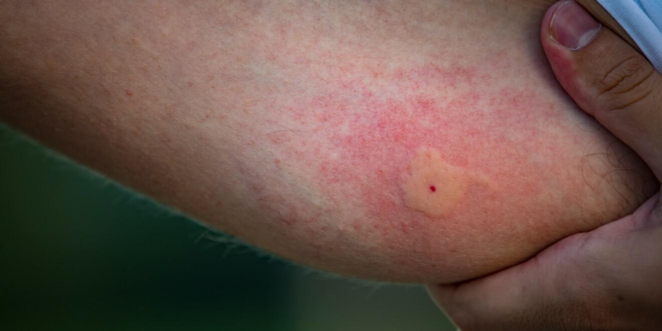 Am I Allergic to Mosquitoes?