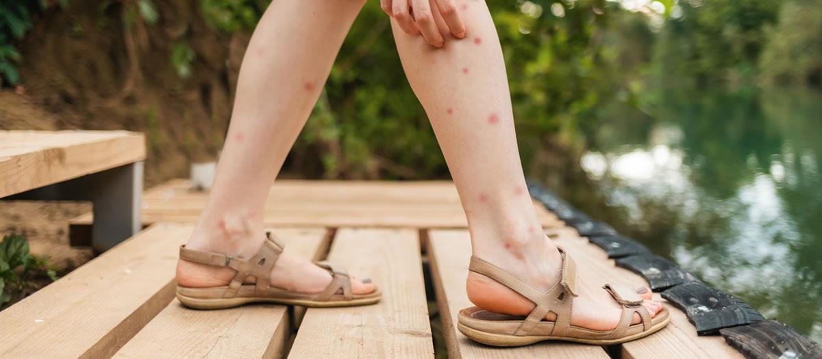 When Should I Be Worried About Mosquito Bites?